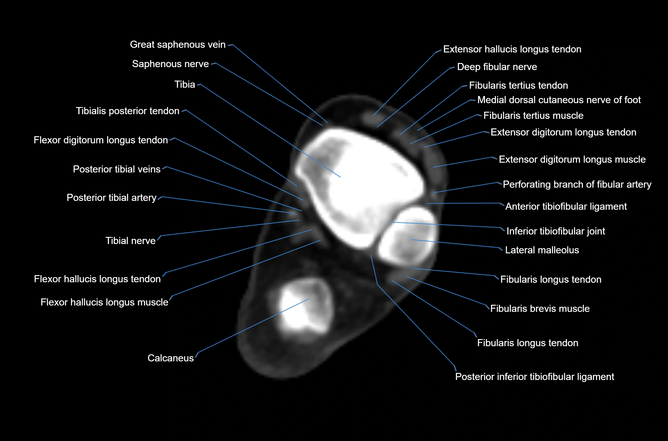 CT Ankle axial cross sectional anatomy labelled image -00028.webp